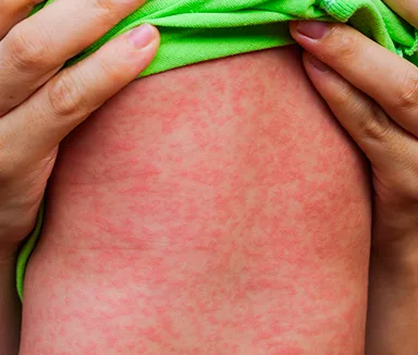 Veja como fica a vacinação contra o sarampo neste fim de semana em SP