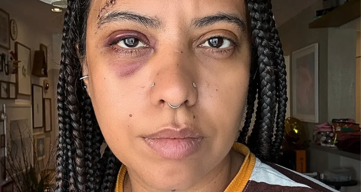 Influenciadora leva seis pontos após agressão em roda de samba no Rio
