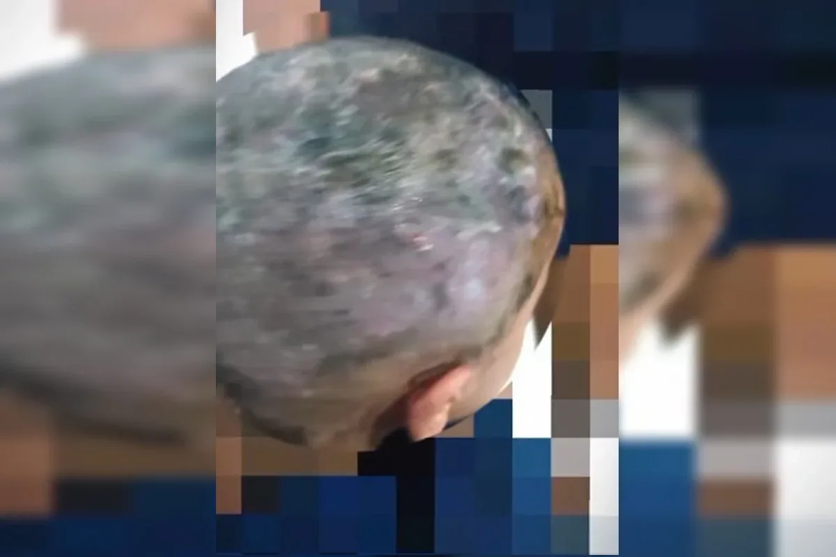 Larvas na cabeça: pais são presos por suspeita de maus-tratos e negligência