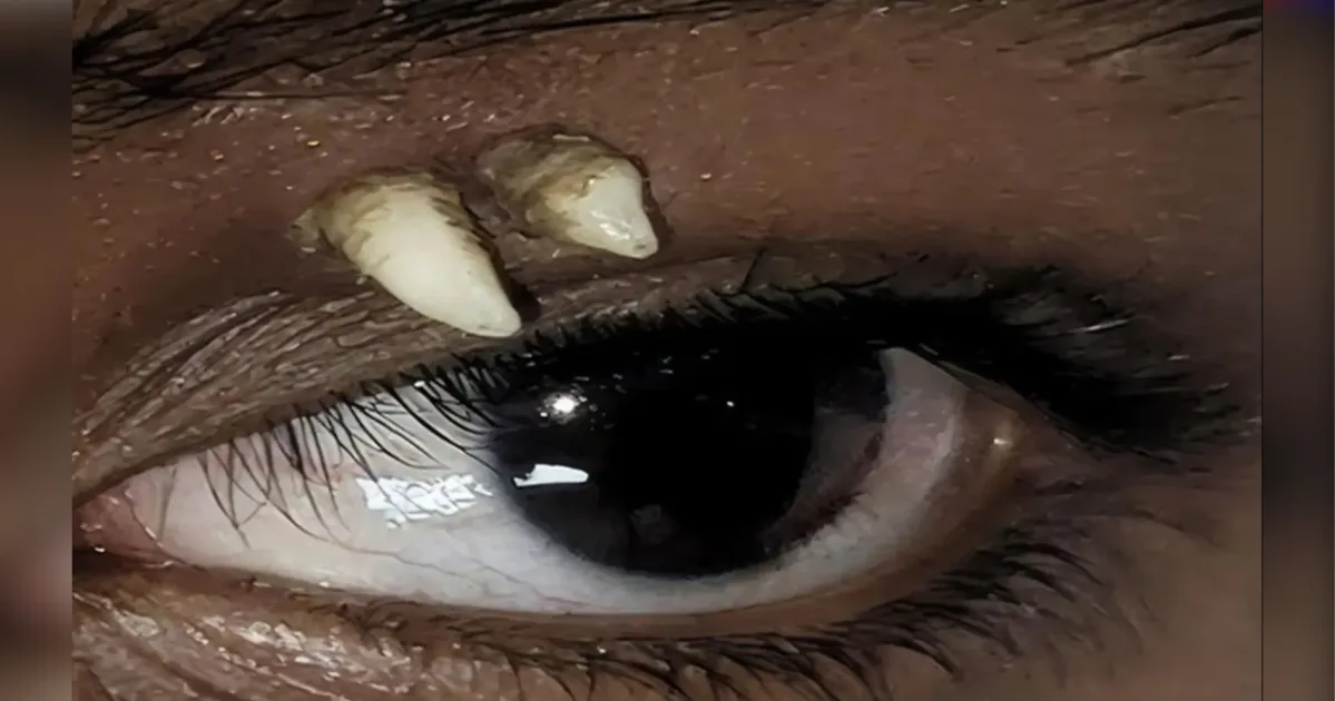 Adolescente na Índia descobre dente crescendo acima do olho; Entenda