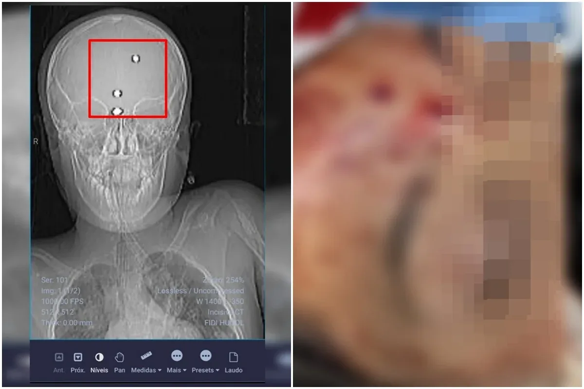 GO: menino baleado com arma de chumbinho deixa UTI após semanas internado