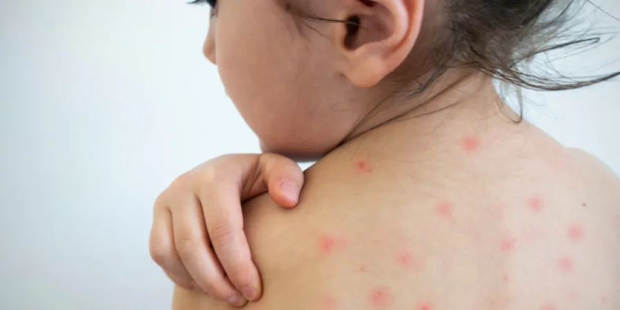 Negacionismo impulsiona sarampo nos EUA e representa ameaça ao Brasil